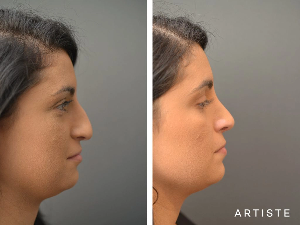 25 Years Old Total Nose Rhinoplasty