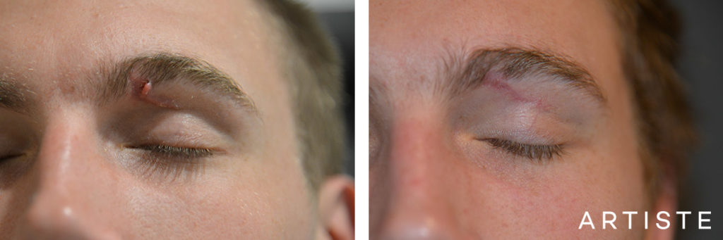 26 Year Old Scar Revision to Left Upper Eye