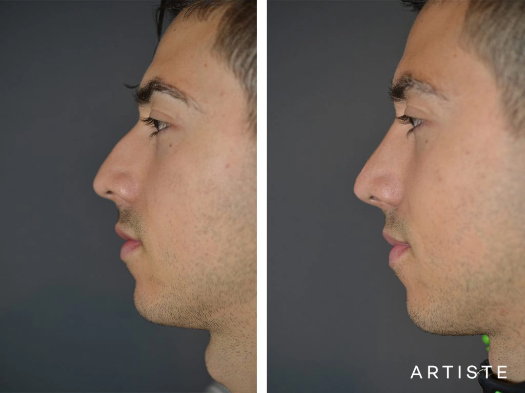 26 Years Old Shape (Dorsal Reduction) Rhinoplasty