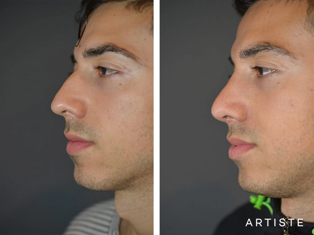 26 Years Old Shape (Dorsal Reduction) Rhinoplasty