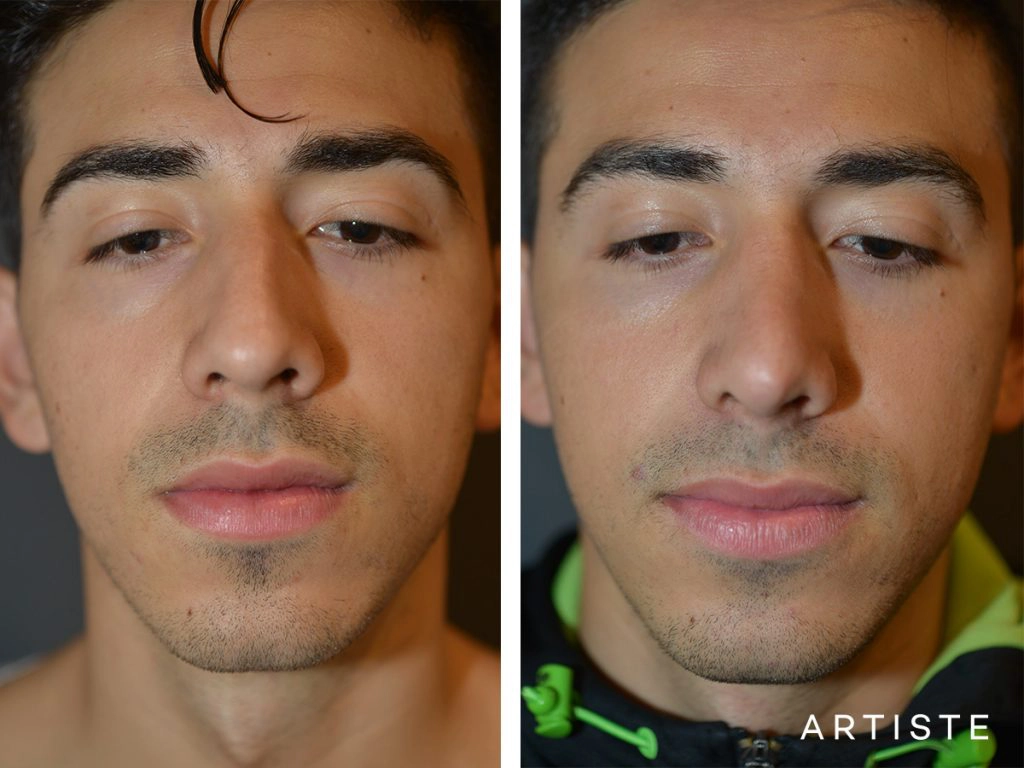 26 Years Old Shape (Dorsal Reduction) Rhinoplasty