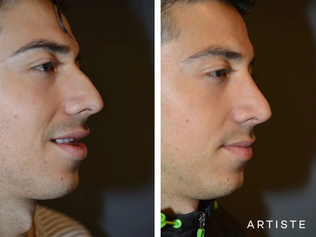 26 Years Old Shape (Dorsal Reduction) Rhinoplasty