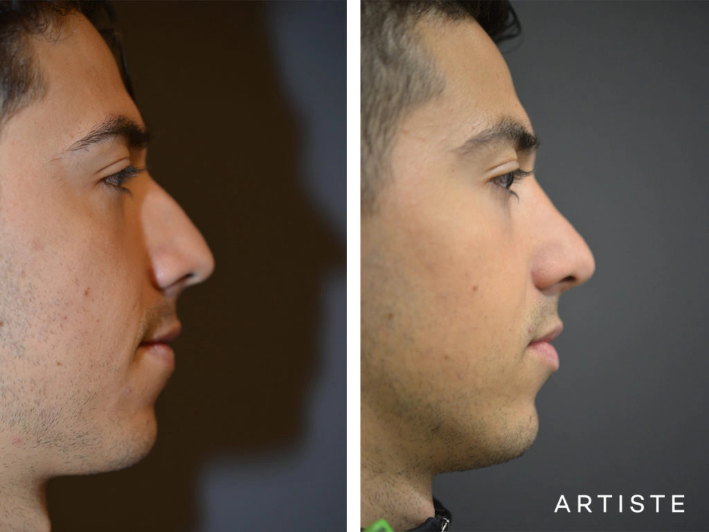 26 Years Old Shape (Dorsal Reduction) Rhinoplasty