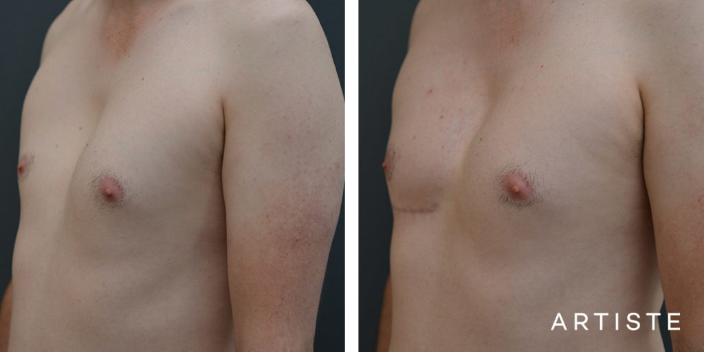 27 Year Old Male Chest Wall Reconstruction Implants