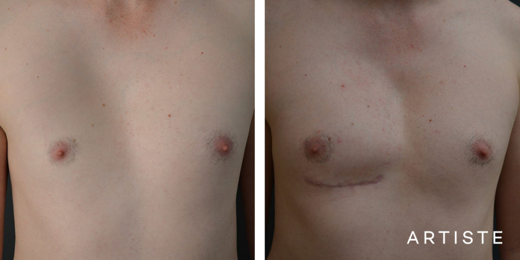27 Year Old Male Chest Wall Reconstruction Implants