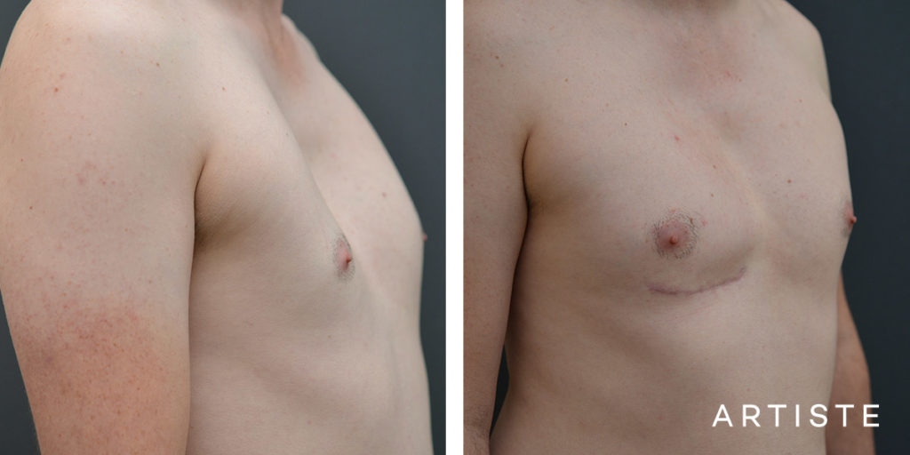 27 Year Old Male Chest Wall Reconstruction Implants