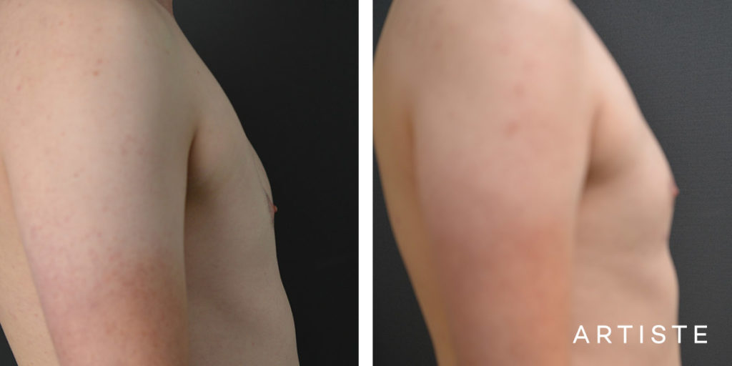 27 Year Old Male Chest Wall Reconstruction Implants