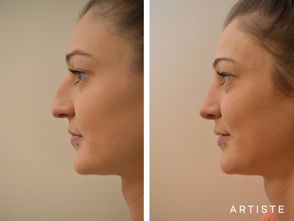 27 Years Old Dorsal + Tip Rhinoplasty