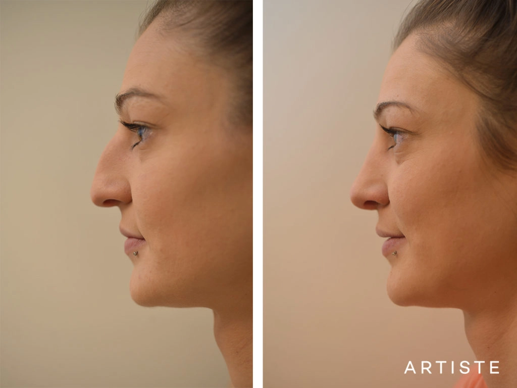 27 Years Old Dorsal + Tip Rhinoplasty