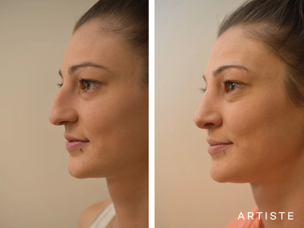 27 Years Old Dorsal + Tip Rhinoplasty