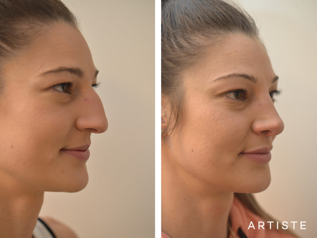 27 Years Old Dorsal + Tip Rhinoplasty