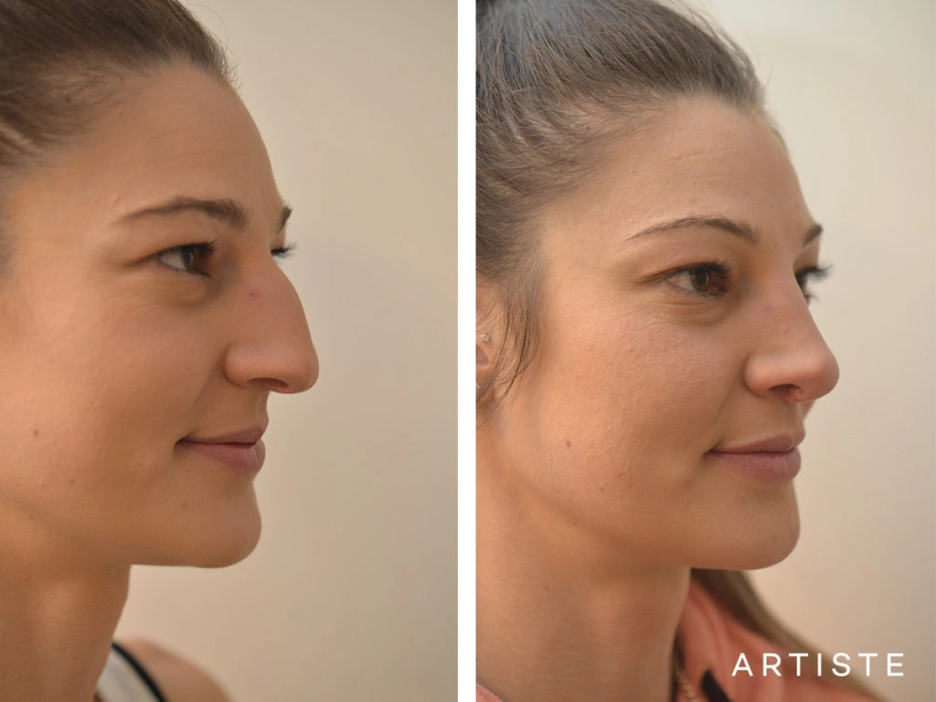 27 Years Old Dorsal + Tip Rhinoplasty