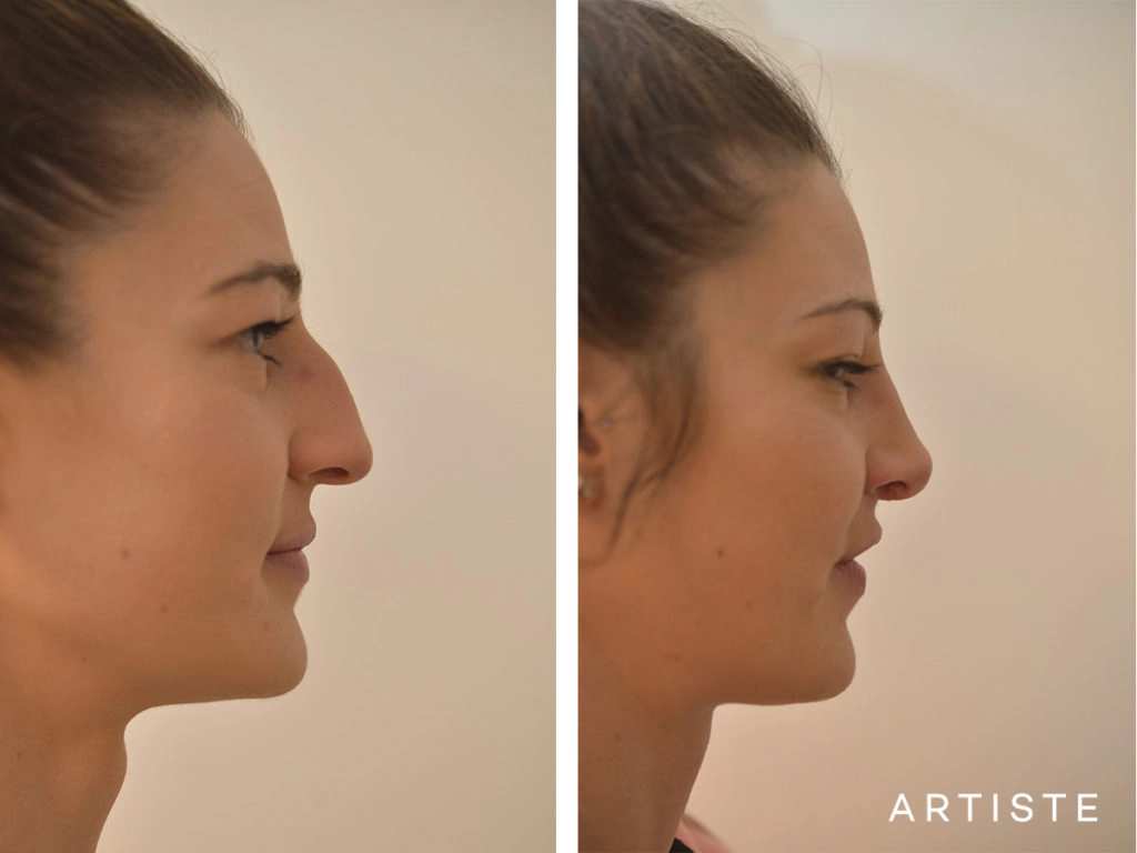 27 Years Old Dorsal + Tip Rhinoplasty