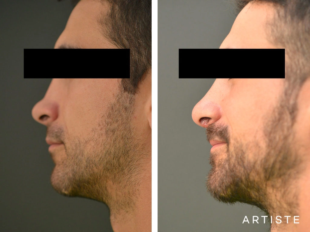 27 Years Old Rib Graft Rhinoplasty