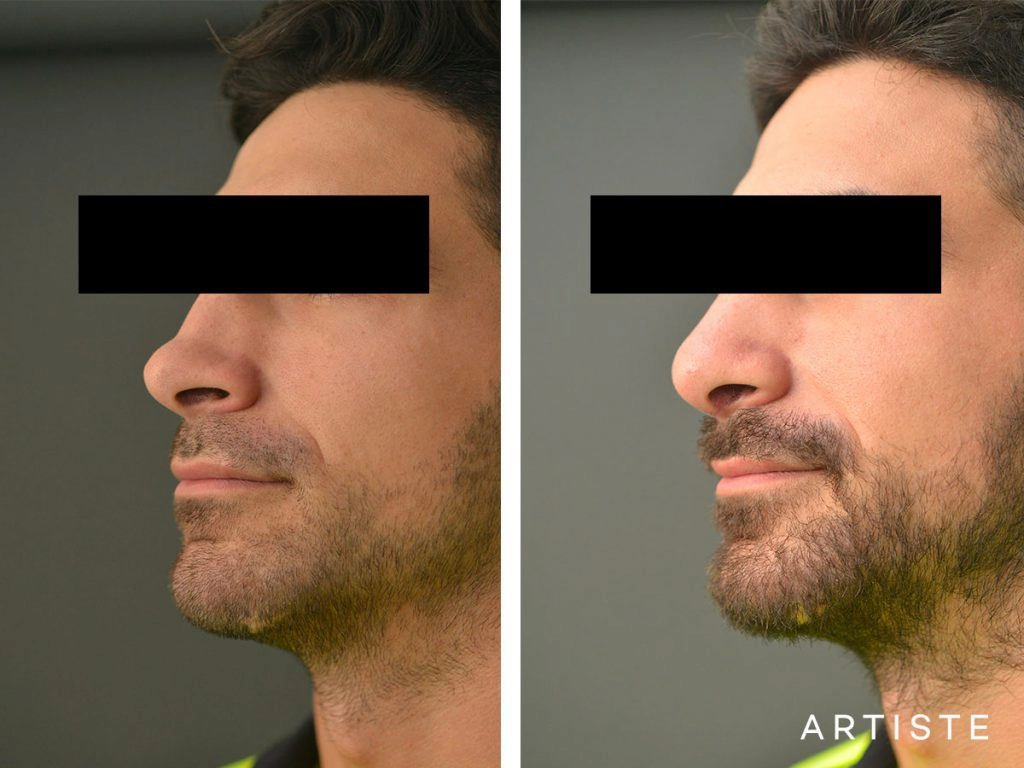 27 Years Old Rib Graft Rhinoplasty