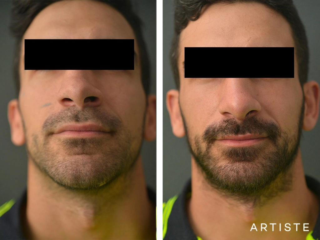 27 Years Old Rib Graft Rhinoplasty