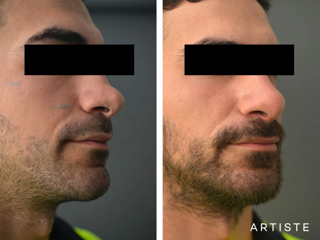 27 Years Old Rib Graft Rhinoplasty