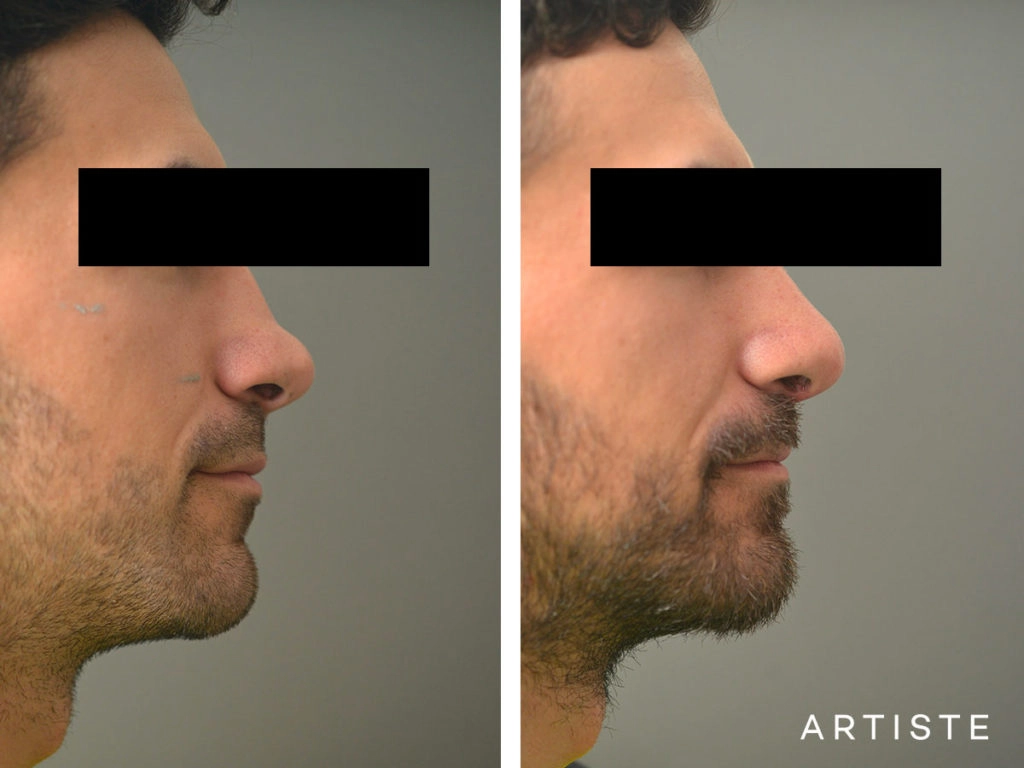 27 Years Old Rib Graft Rhinoplasty