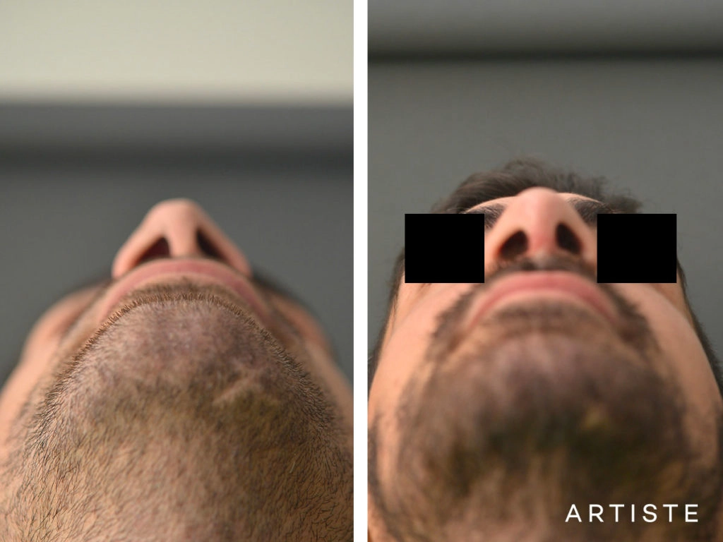 27 Years Old Rib Graft Rhinoplasty