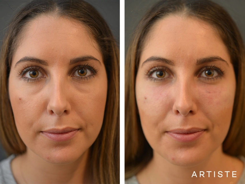 30 Years Old Tear Trough Filler