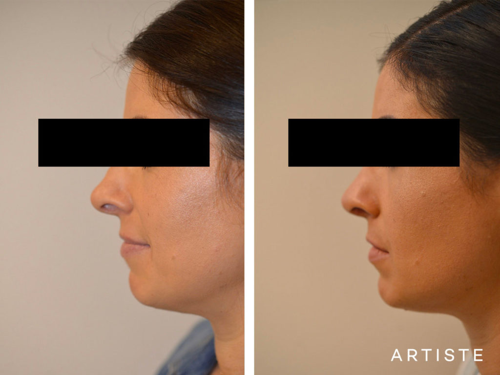 30 Years Old Revision Rhinoplasty