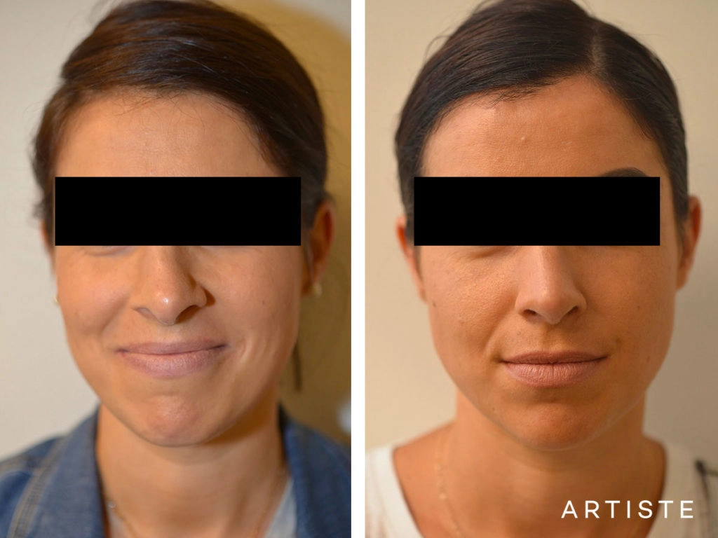 30 Years Old Revision Rhinoplasty