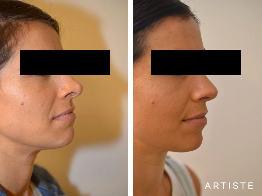 30 Years Old Revision Rhinoplasty