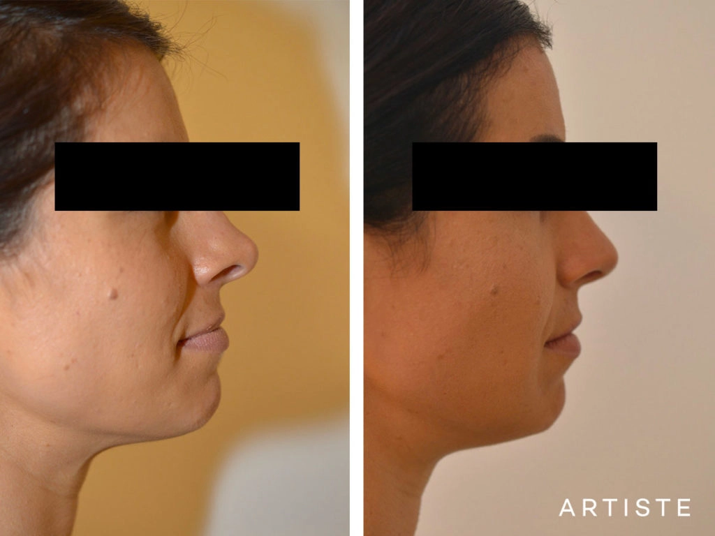 30 Years Old Revision Rhinoplasty