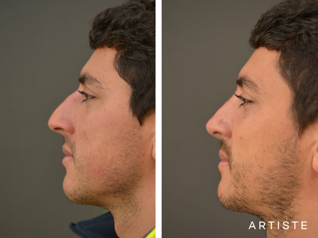 31 Years Old Shape (Dorsal Reduction) Rhinoplasty
