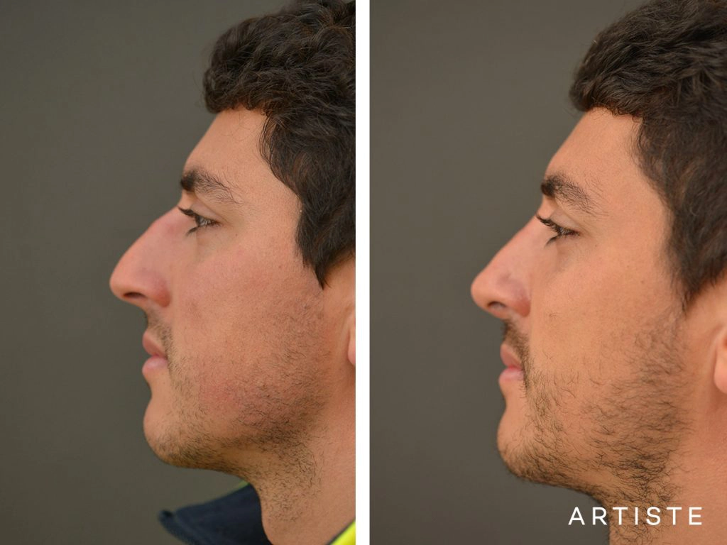 31 Years Old Shape (Dorsal Reduction) Rhinoplasty