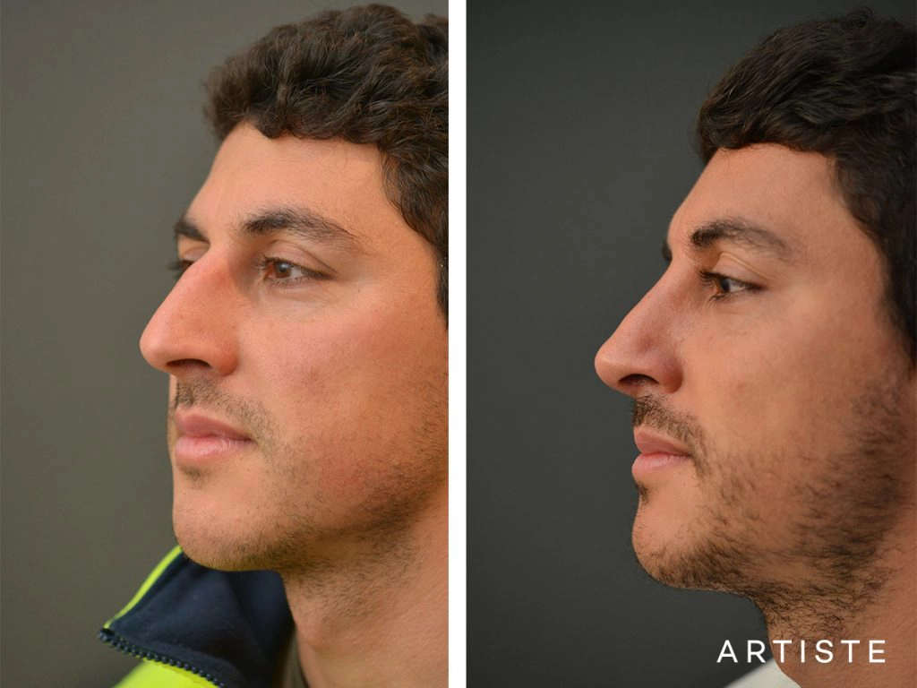 31 Years Old Shape (Dorsal Reduction) Rhinoplasty