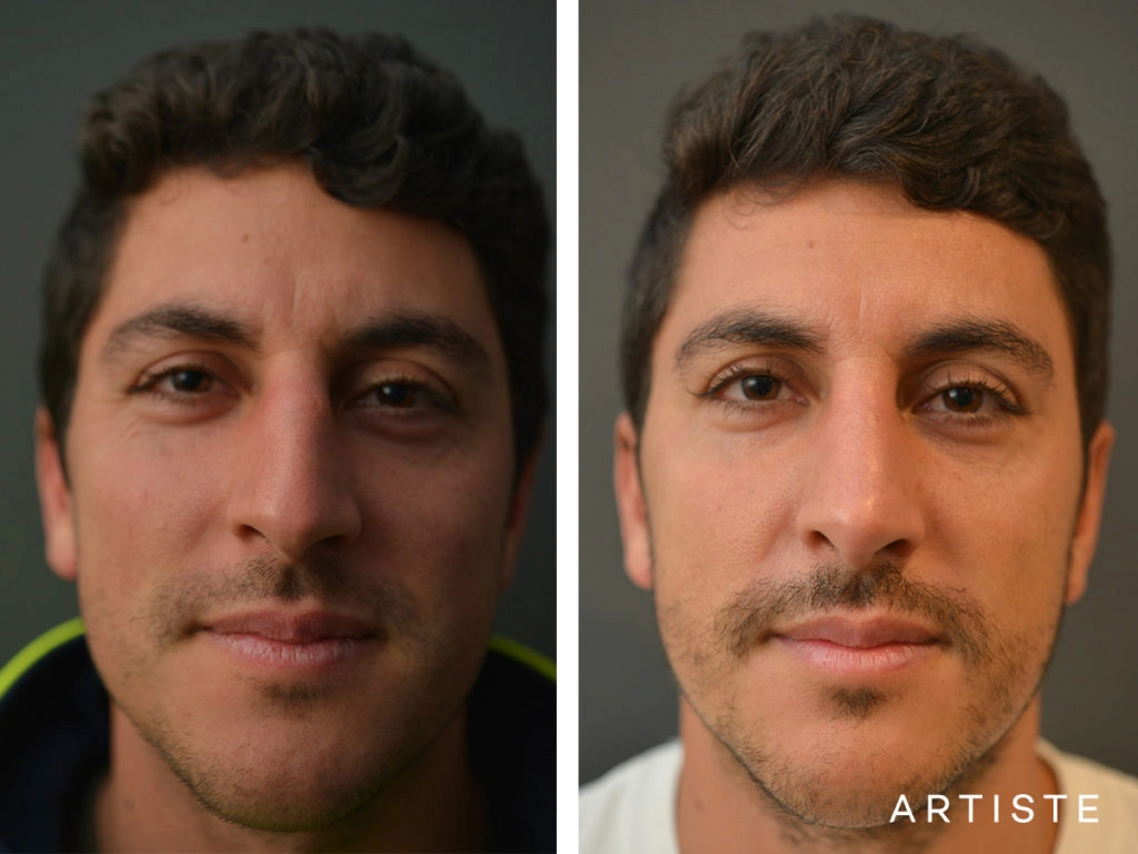 31 Years Old Shape (Dorsal Reduction) Rhinoplasty