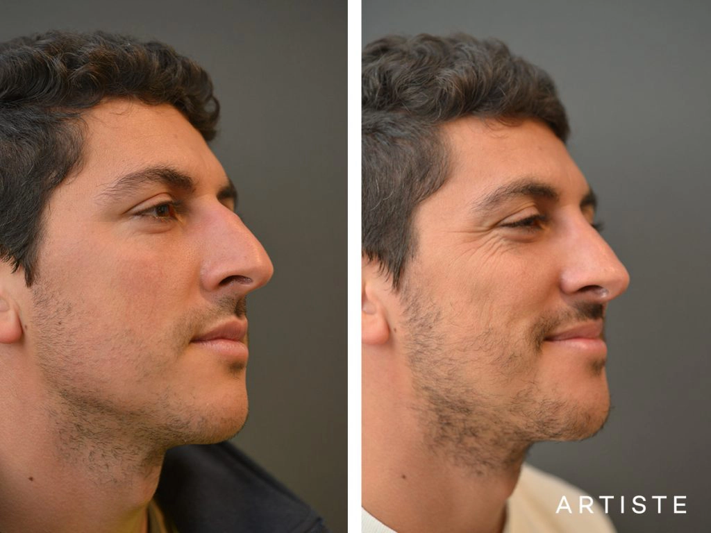 31 Years Old Shape (Dorsal Reduction) Rhinoplasty