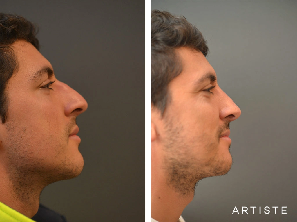 31 Years Old Shape (Dorsal Reduction) Rhinoplasty