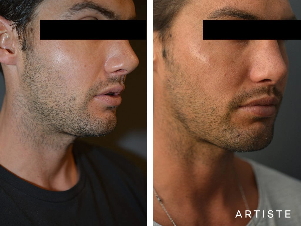 32 Years Old with Facial Filler to Cheek + Jaw Line