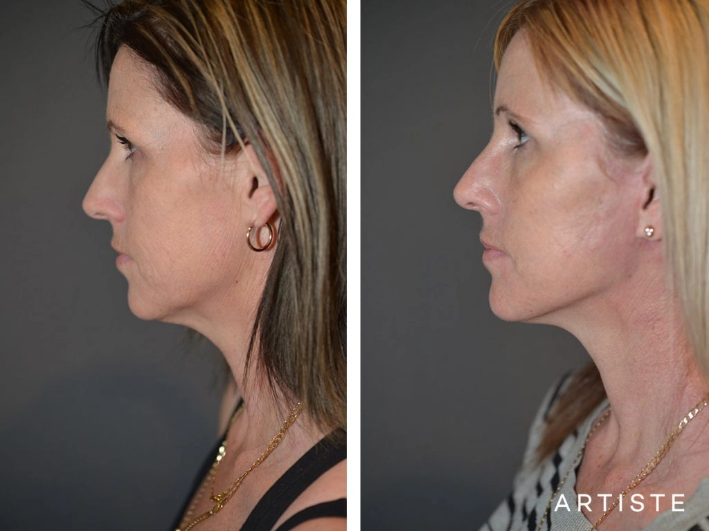 37 Year Old: Deep Plane Facelift, Structural Fat Grafting, Chemical Peel