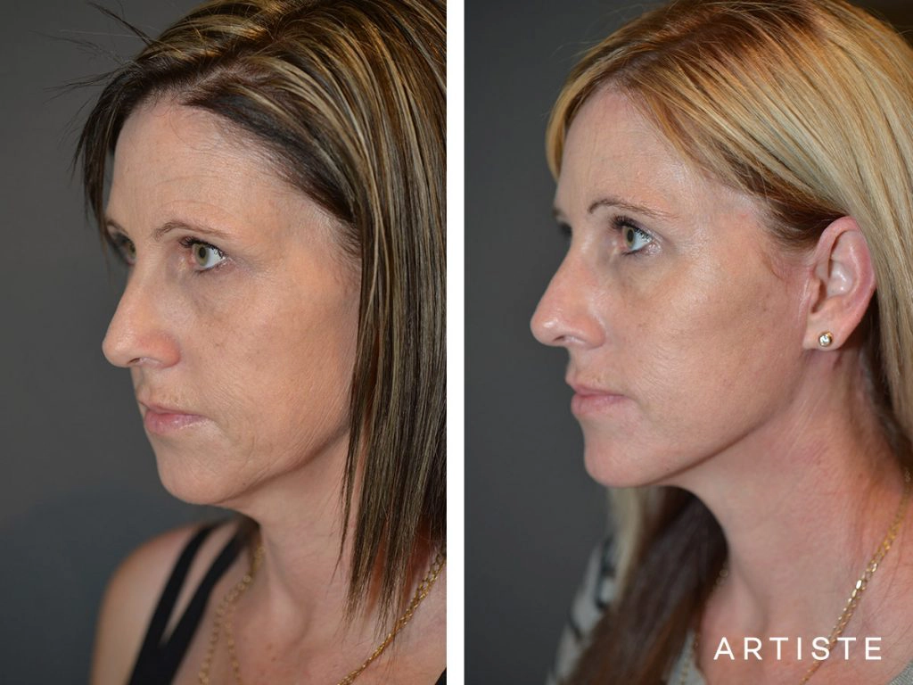 37 Year Old: Deep Plane Facelift, Structural Fat Grafting, Chemical Peel