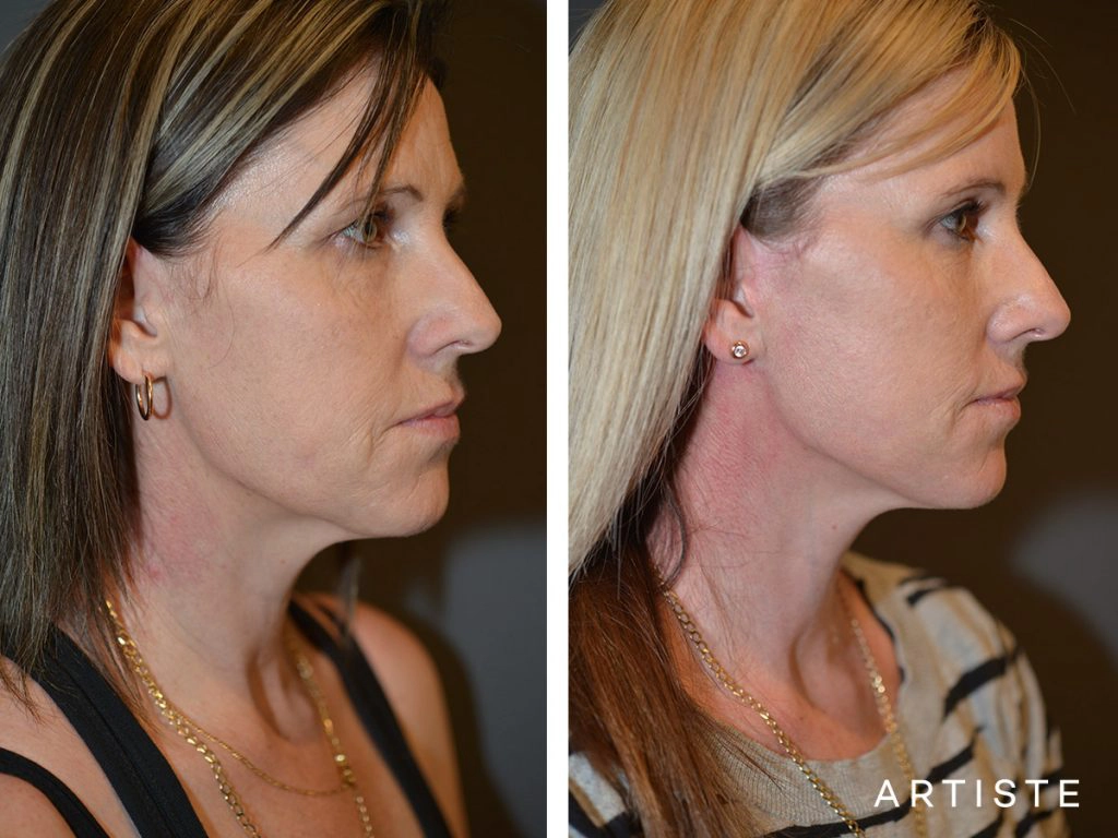 37 Year Old: Deep Plane Facelift, Structural Fat Grafting, Chemical Peel