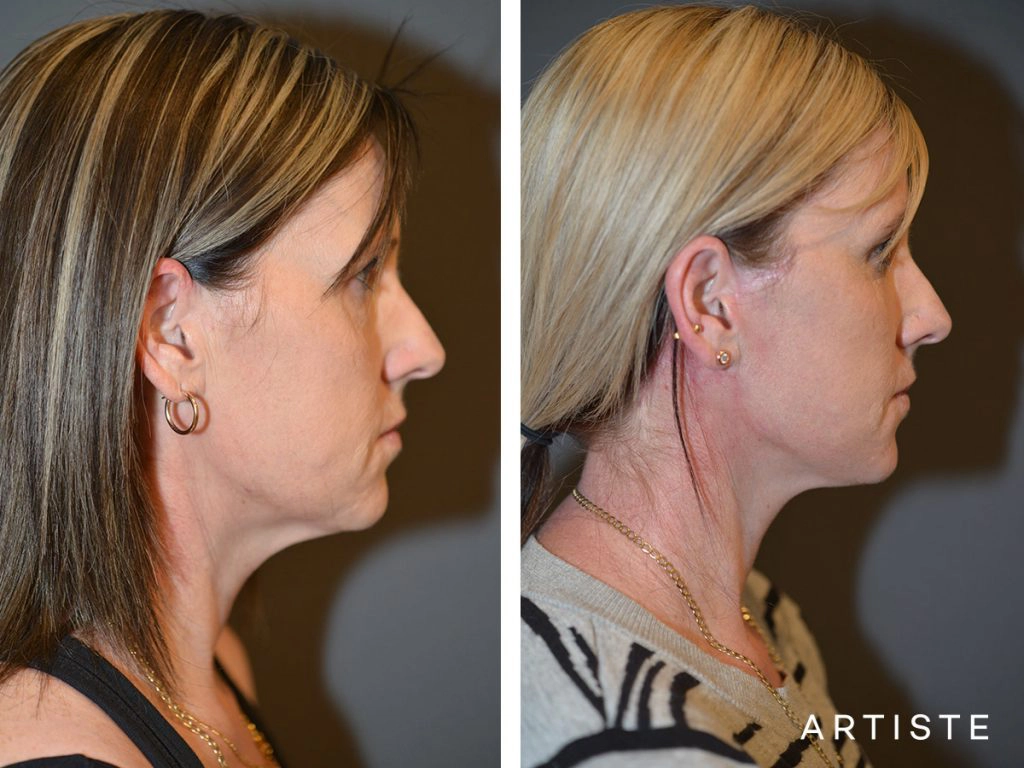 37 Year Old: Deep Plane Facelift, Structural Fat Grafting, Chemical Peel