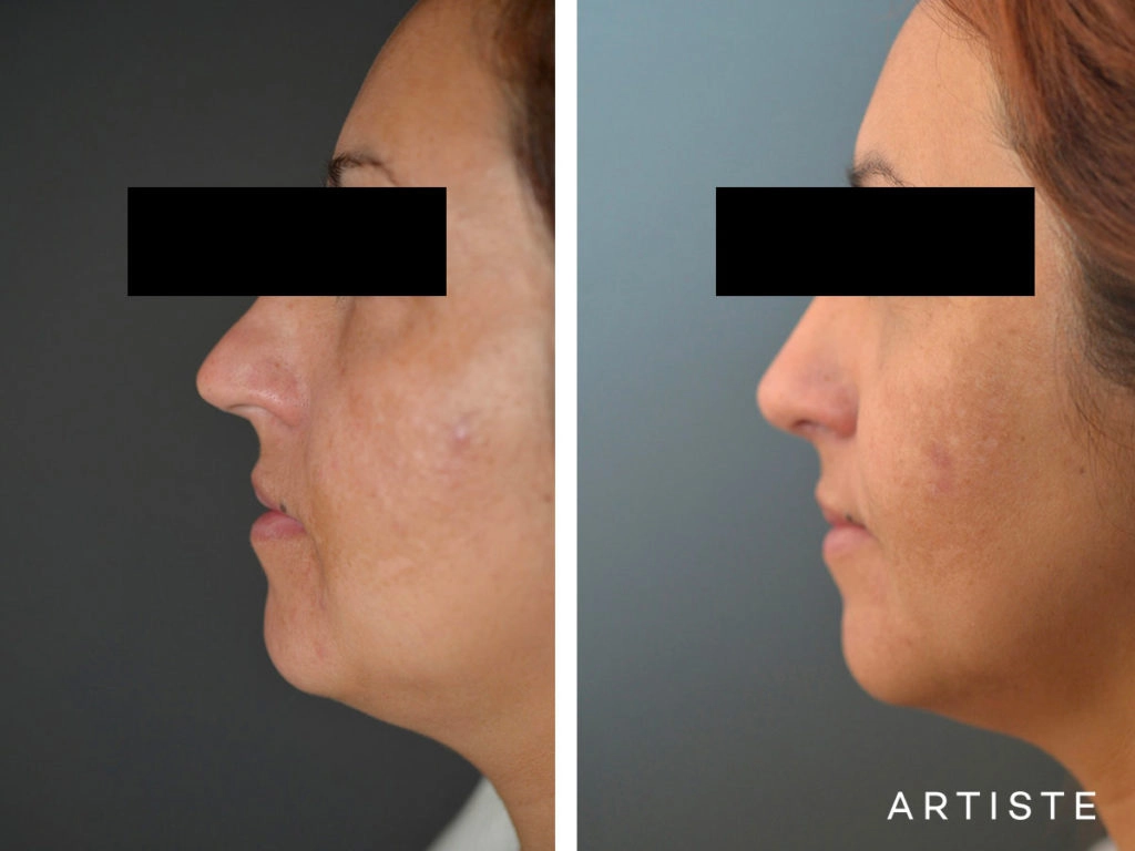 40 Years Old Total Nose Rhinoplasty