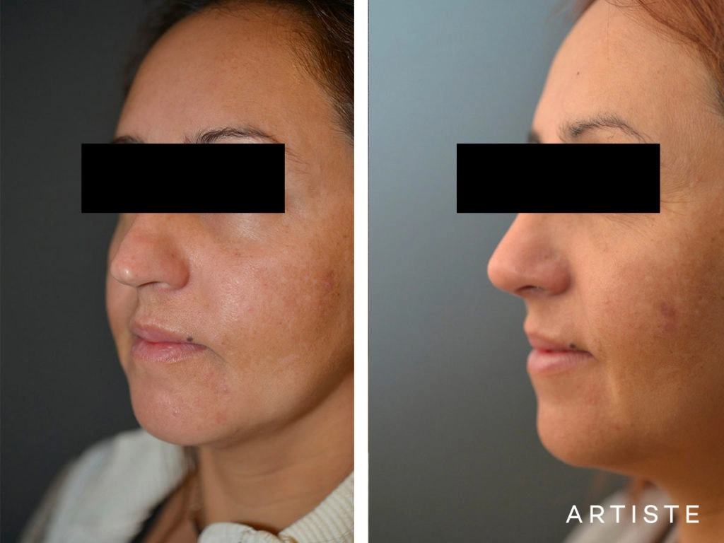 40 Years Old Total Nose Rhinoplasty