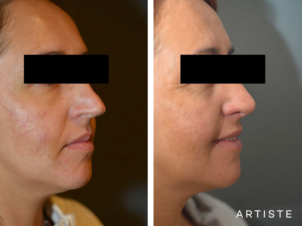 40 Years Old Total Nose Rhinoplasty