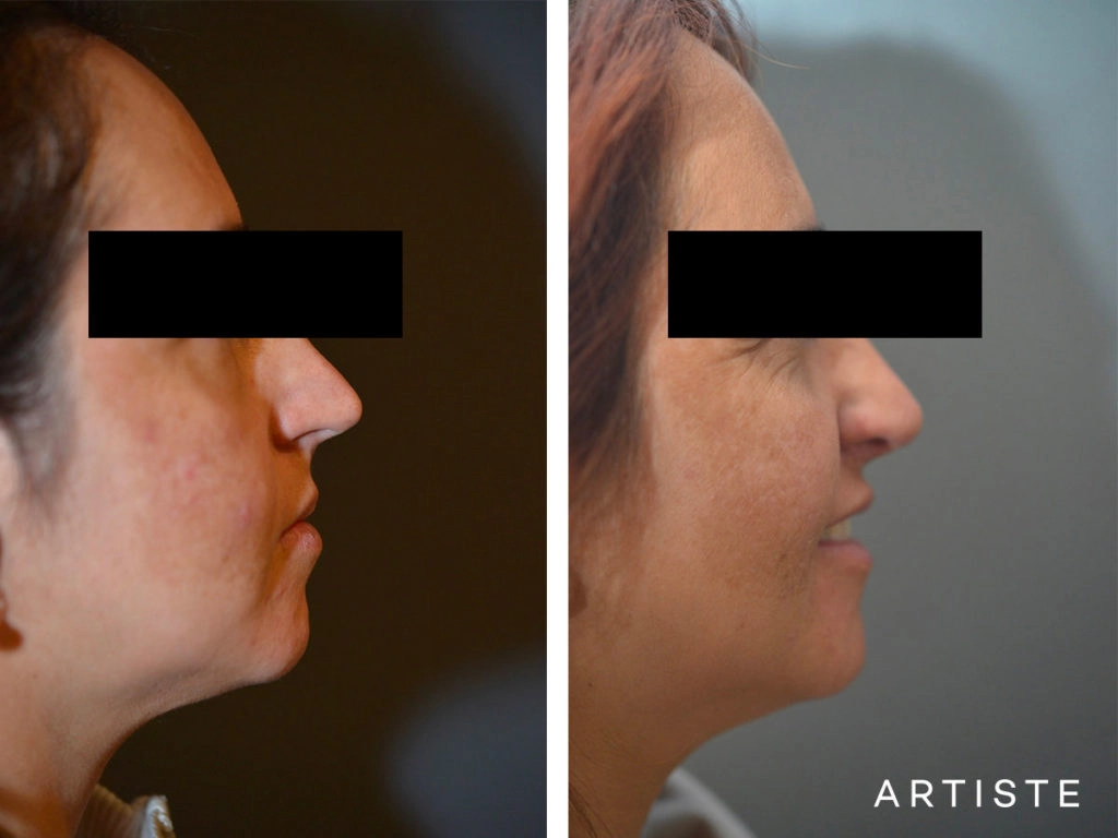 40 Years Old Total Nose Rhinoplasty