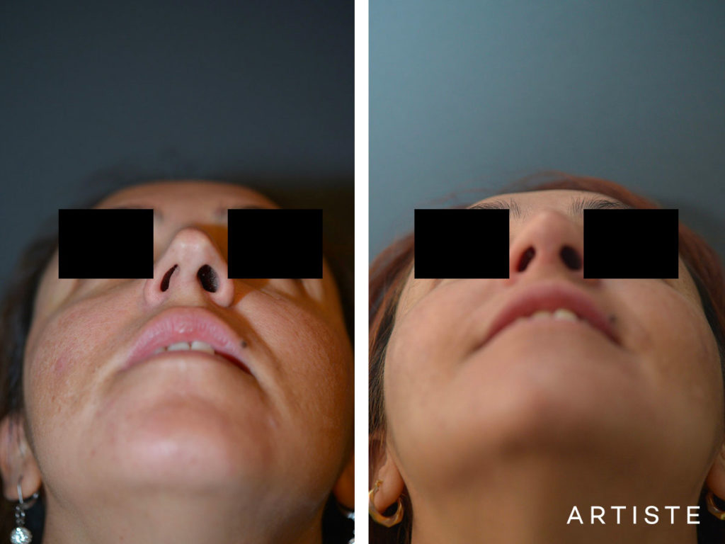 40 Years Old Total Nose Rhinoplasty
