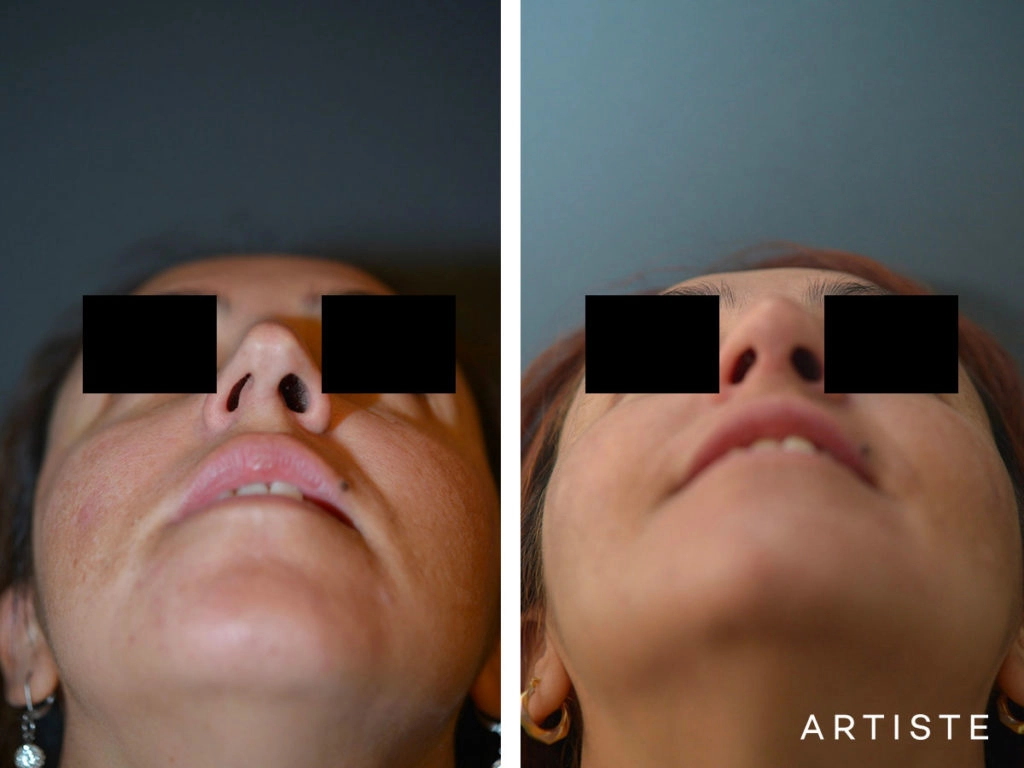 40 Years Old Total Nose Rhinoplasty