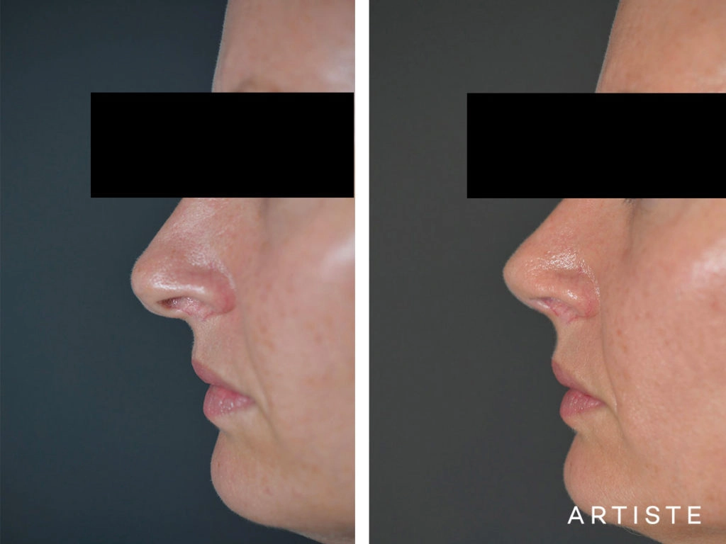 41 Years Old Total Nose Rhinoplasty