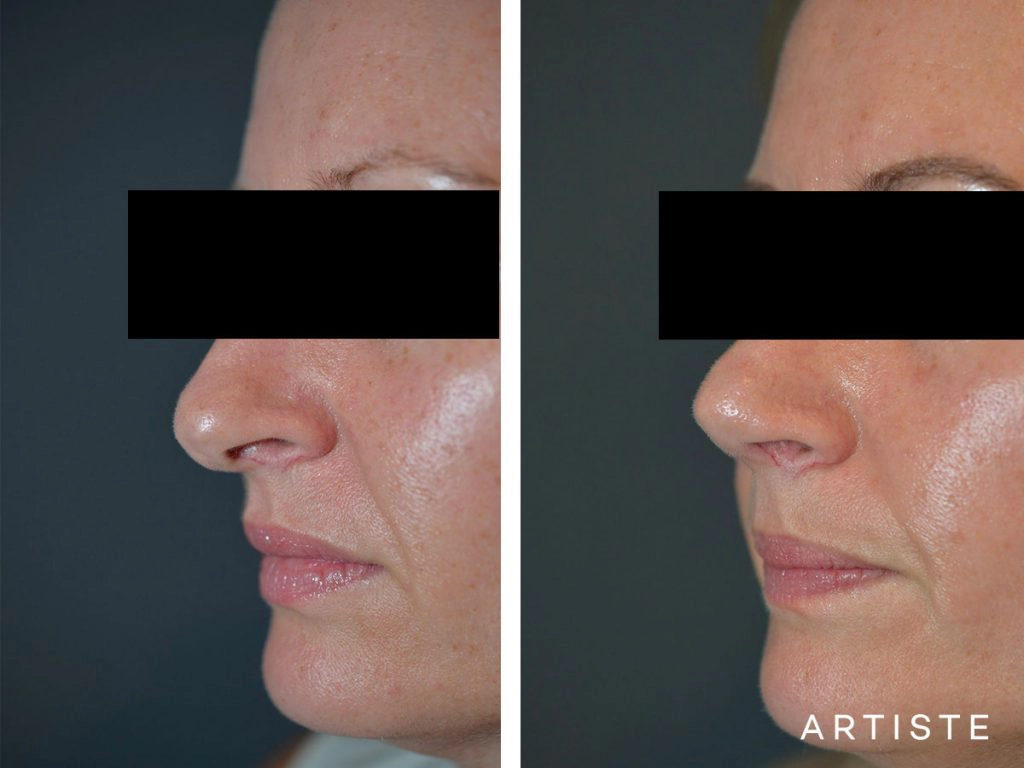 41 Years Old Total Nose Rhinoplasty