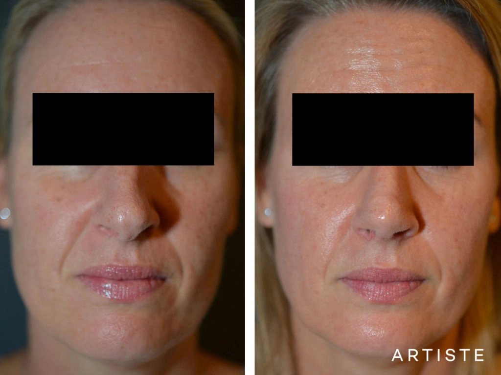 41 Years Old Total Nose Rhinoplasty