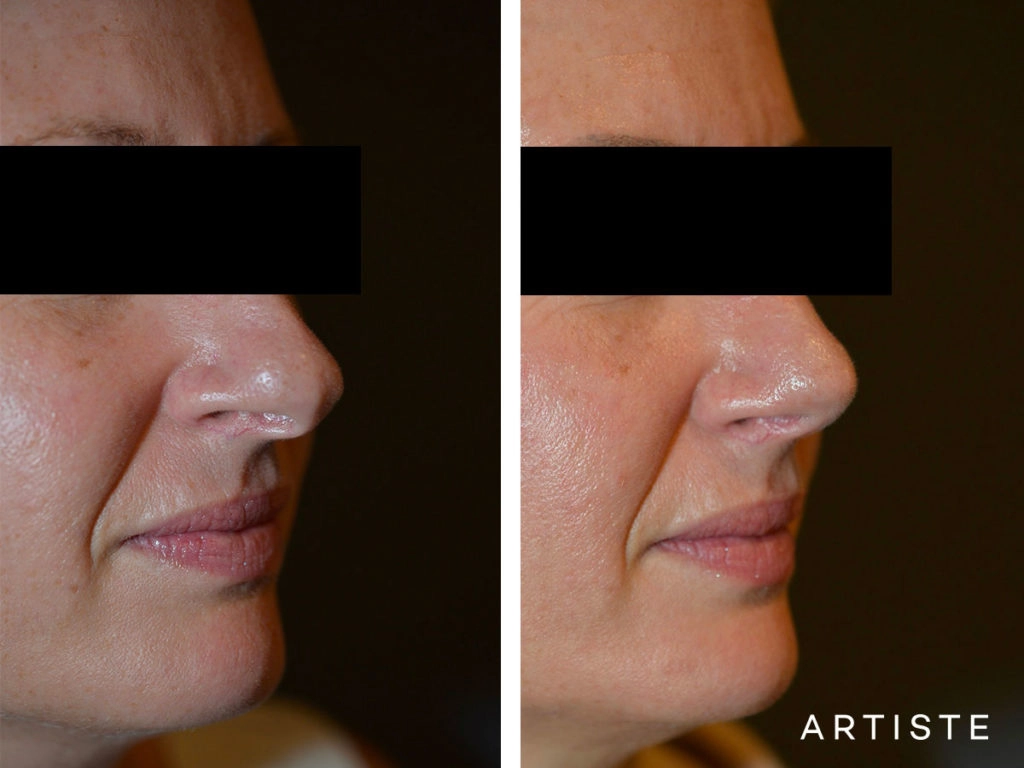 41 Years Old Total Nose Rhinoplasty