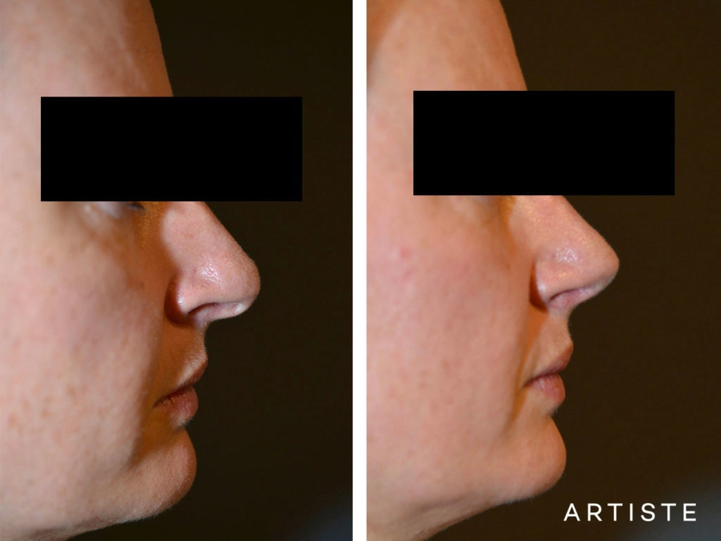 41 Years Old Total Nose Rhinoplasty